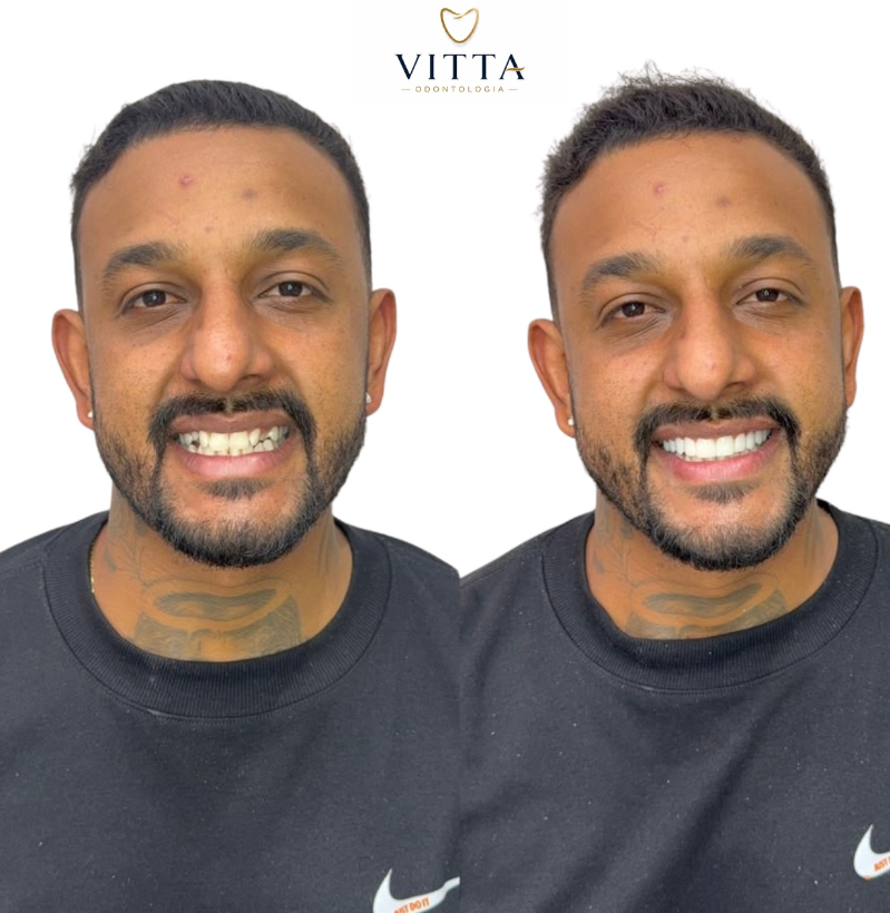 Caso de sucesso Odontologia Estética 1