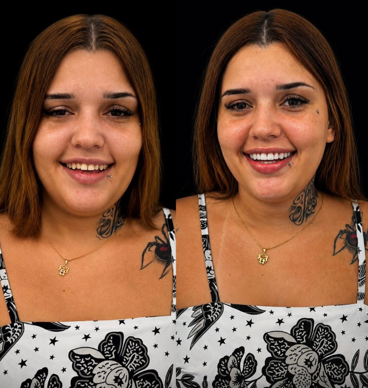 Caso de sucesso Odontologia Estética 3