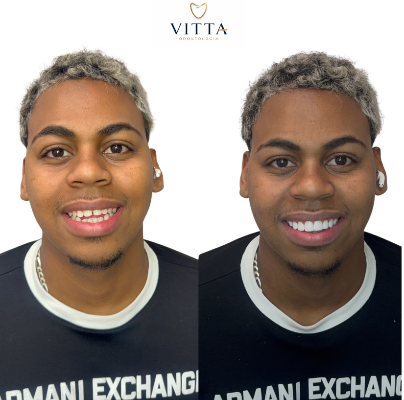 Caso de sucesso Odontologia Estética 4
